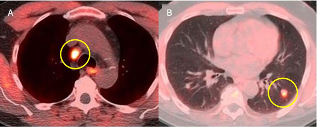 PET-CT 