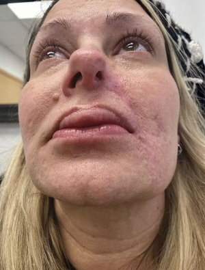 美 50대​ 여성, 필러 맞고 코 한쪽 녹아내려… 어떻게 된 일?