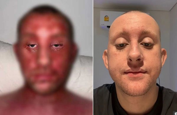 “매일 바르던 ‘이 약’ 끊었더니”… 피부 벗겨지고 진물 공황발작도, 무슨 일?