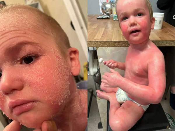 “각질이 온몸 뒤덮어”… ‘피부병’으로 고통 받는 英 남아, 무슨 일?