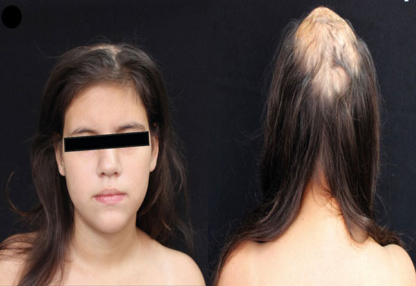 “13세 소녀, 정수리가 텅…” 희귀질환 때문이라는데, 정체 뭐길래?