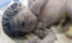 드물지만, 신화 속 ‘외눈박이’ 실제로 존재… ‘단안증’ 사례 살펴 보니?