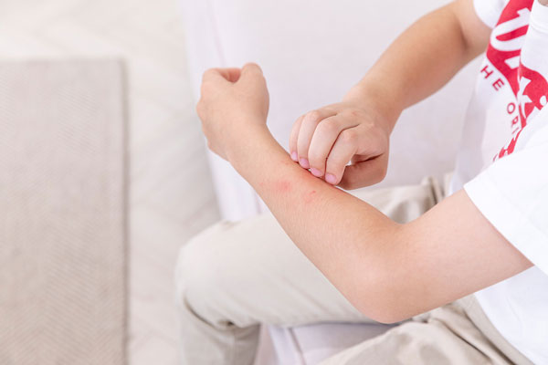 밥보다 간식 좋아하는 아이, 아토피 피부염 심하게 겪는다