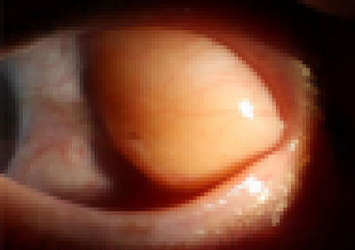 “눈에 저게, 지방이라고?” 대체 왜 튀어나왔나 봤더니…