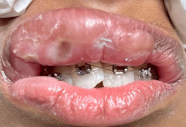 “교정 치료하다 입술 퉁퉁”… ‘이것’ 알레르기 때문이라는데, 뭐길래?