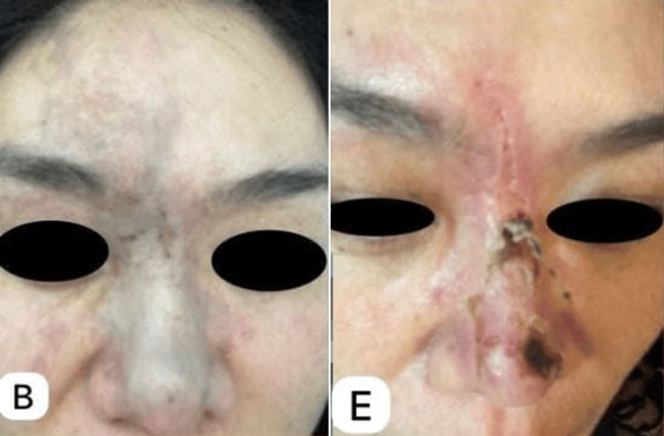 “성형외과서 많이 하는데…” 점차 멍 들더니 고름까지, 부작용 이렇게 심하다고?