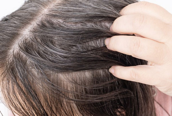 지성 두피, 머리 떡지는 것도 슬픈데… 탈모도 취약?