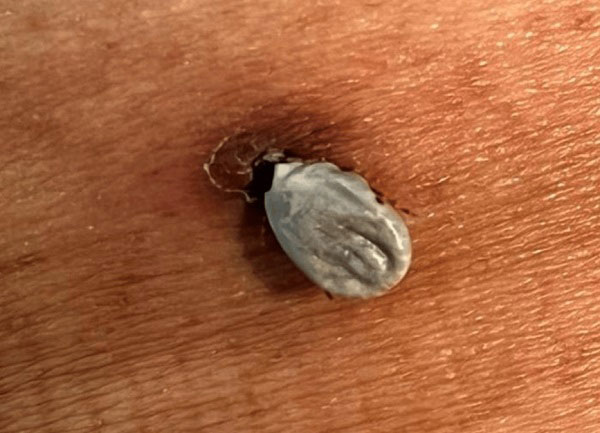 “한 달 넘게 ‘옆구리’에 붙어 있어…” 퉁퉁 부풀어 오른 진드기, 무슨 일?