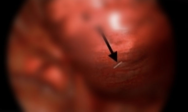 “근육통 주사 맞았다가, 갑자기 호흡곤란”… 사진 찍어보니 폐에 ‘이것’ 박혀 있어