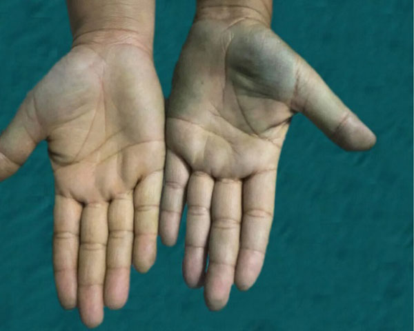 “불면증 때문에 ‘이 약’ 먹었다가…” 손 파랗게 변해, 왜 이런 일이?