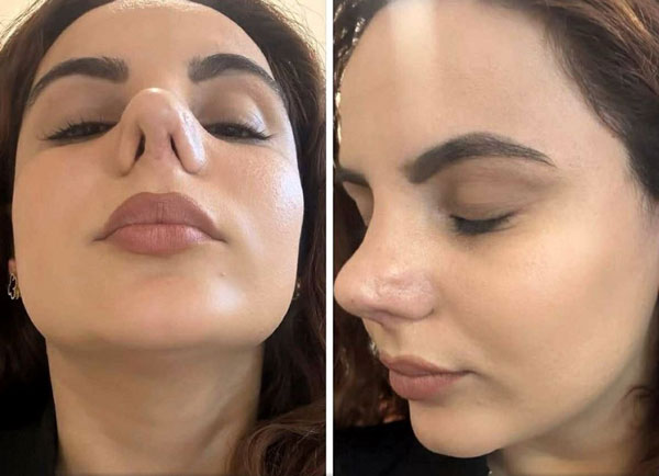 세 차례 코 수술 실패 ‘부작용’ 극심… “더 이상 살 수 없다”, 무슨 사연?