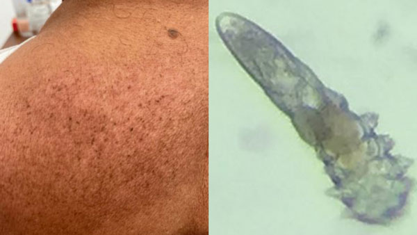 “밤마다 가렵더니, 벌레가 바글바글”… 60대 男 피부, 대체 무슨 일?