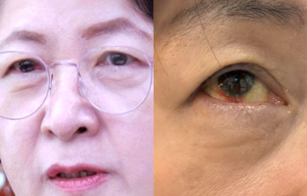 추미애 “눈 실핏줄 터졌다”… 국감 끝나고 병원 찾은 이유는?