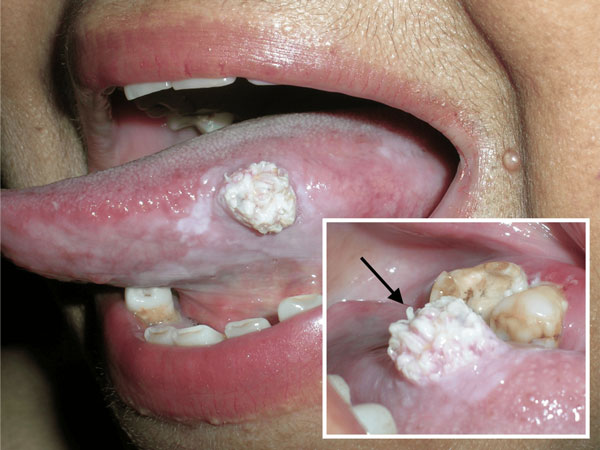 “콜리플라워인 줄” 60대 男, 혀에 ‘이 증상’ 생기더니 암 진단… 모습 보니?