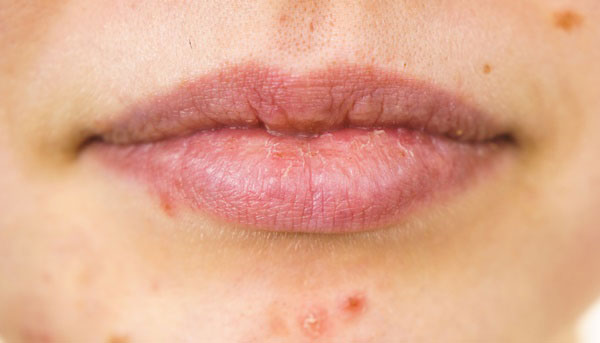 입술이 간질간질… 구순염 왜 생겼나 보니, 오늘 쓴 ‘이것’ 때문