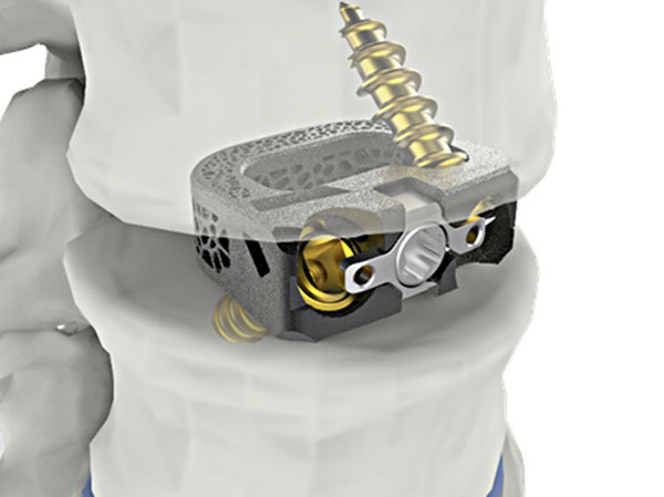 시지메드텍 “척추 임플란트 ‘유니스페이스’ 美 FDA 승인”