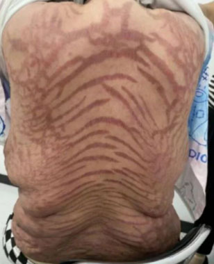 “쉽게 구하는 약인데”… ‘이것’ 발랐다가 몸에 뱀 무늬 생긴 女, 무슨 일?