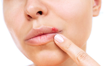 피곤하니 올라온 입술 물집, 남자친구의 ‘성병’ 오해… 진실은?