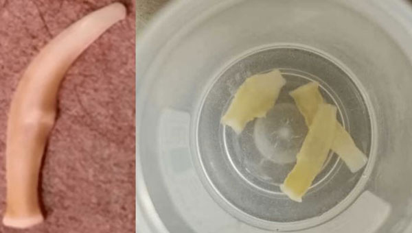 10대 女, “항문 가렵더니, 대변에서 벌레가”… ‘이 음식’이 화근이었다