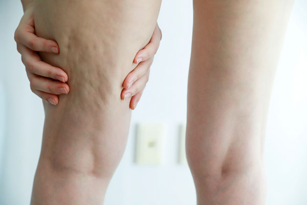 “다리가 왜이리 두꺼워졌지?” 부은 건지, 지방 쌓인 건지 확인하는 법