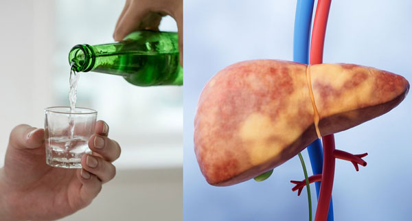 “소주 두 잔도 위험” 세계 인구 40%가 지방간에 시달리는 중