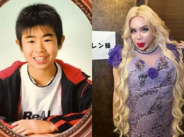 “왕따 극복하고 싶어 성형했다”… 10억 원 투자한 30대 男, 모습 보니?