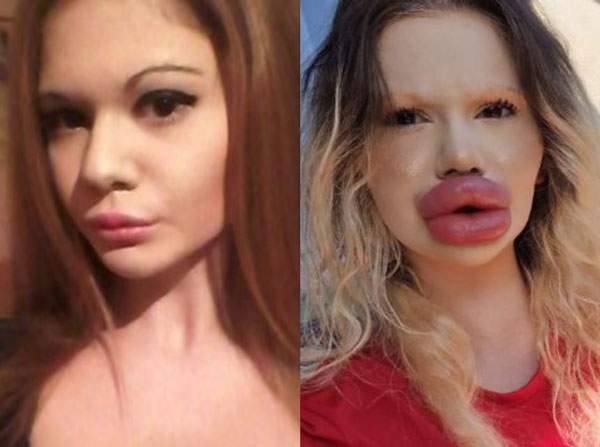 “필러 놔줄 의사 구해요” 20대 女 입술에 의사도 ‘경악’… 어떻길래?