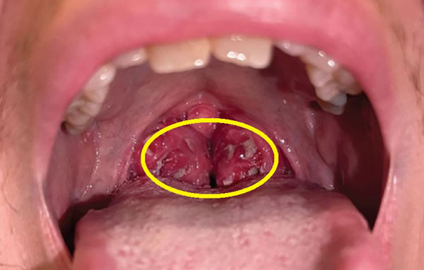 美 36세 남성, “여자친구 만난 후 편도 붓고, 고름까지”… ‘키스병’을 아시나요?