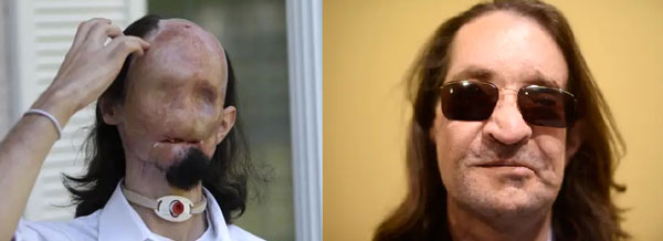 “어느 날 눈코입이 사라졌다” 얼굴 녹아내린 男, 무슨 사연인지 보니?