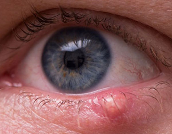 영양주사 맞으니 되레 커진 다래끼… 알고보니 '암'이었다