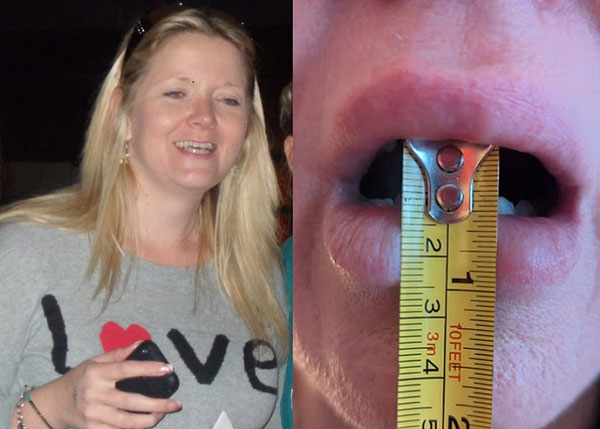 “겨우 1.4cm 벌어져” 47세 女, 턱 기능 망가뜨린 ‘흔한 이 습관’… 뭘까?