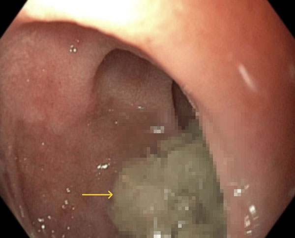 “피자 먹다가, 가슴 아파” 식도에 ‘이것’ 잔뜩 남아 있었다… 사진 보니?