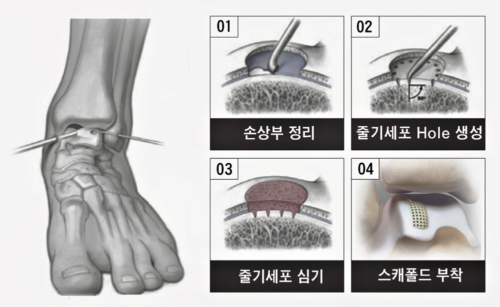 발목 연골 손상은 '시간'이 만든 균열