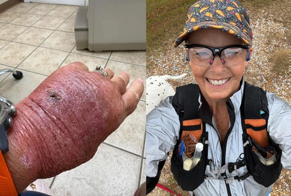 “종이에 베였을 뿐인데…” 60대 女 끔찍한 감염, 무슨 일?