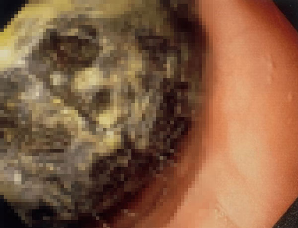 “뱃속에 계속 쌓였다”… 20대 女, 대체 뭘 먹었길래?