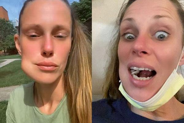 “턱 점점 붓더니”… ‘암’ 진단받은 30대 女, 증상 보니?