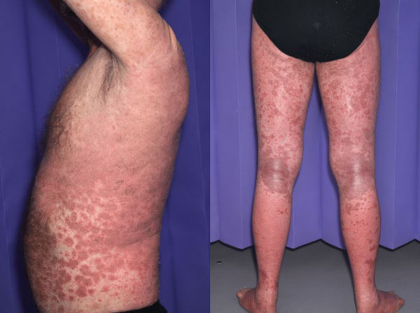 “매일 ‘이것’ 한 알씩 먹다가…” 60대 男 피부, 대체 무슨 일?