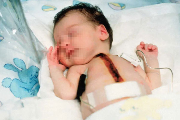 논란 여전하지만… ‘개코원숭이의 심장’ 받고 21일 생존한 아기