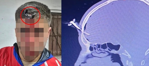 “머리에 자동차 열쇠 꽂혀” 30대 男, 목숨 건졌다던데… 무슨 일?