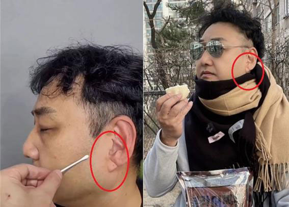 “귓불에 주름 있는데, 심장마비 위험한 걸까?”… 걱정될 때 ‘이 검사’ 받자