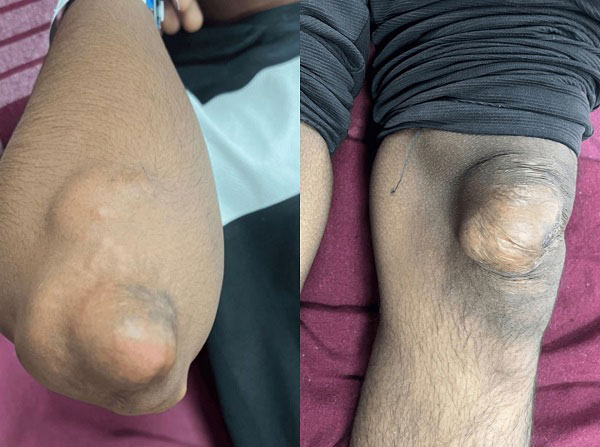 20대 男 “엉덩이에 노란 덩어리가”… 몸속에서 ‘이것’ 폭발 중이라는 신호였다