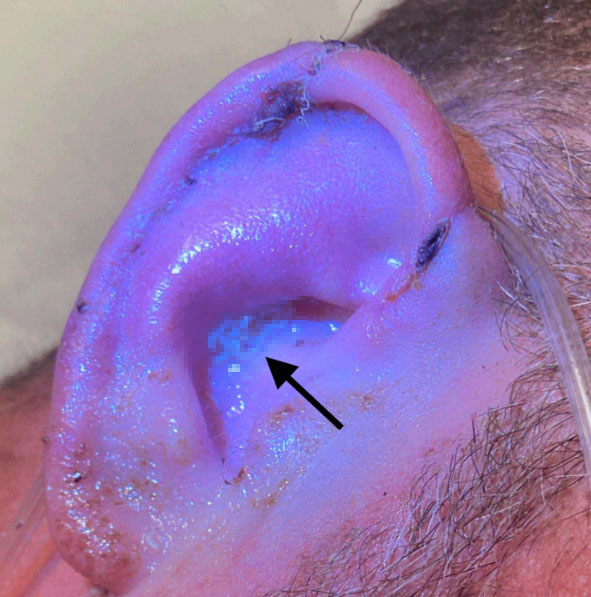 “매일 아프더니, 벌레가 바글바글”… 40대 男 귀, 대체 무슨 일?