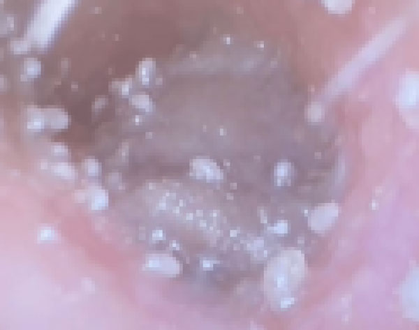 “귀 계속 아프더니, ‘이 벌레’ 바글바글”… 20대 女, 무슨 일?