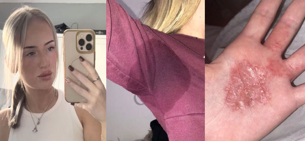 매일 옷 세 번씩 갈아입고, 샤워는 다섯 번… '이 증상' 탓 괴롭힘도 당한 女, 무슨 일?