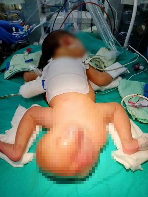 막 태어난 아기 엉덩이에… 대체 무슨 일?