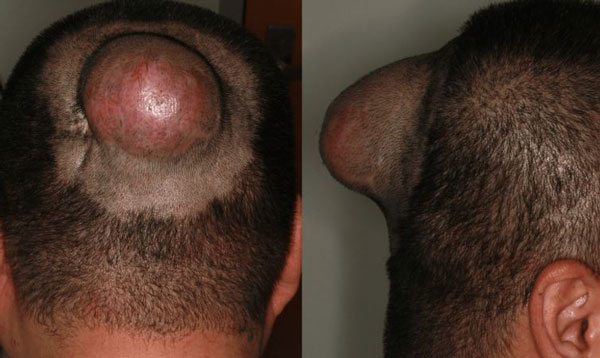 40대 男 “두피 혹, 점점 커져”… 제거하고 보니, 정체는?