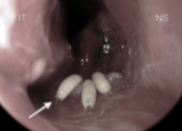 “콧속에 벌레가 득실득실”… 5세 남아, 원인 뭐였나 보니?
