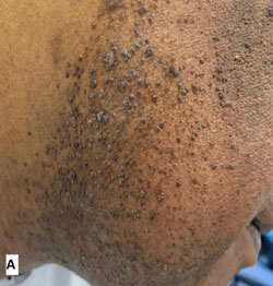 “얼굴에 오돌토돌”… 40대 男 ‘이 바이러스’ 감염이라던데, 무슨 일?