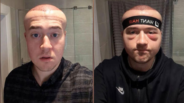 “외계인처럼 머리 부풀어”… 20대 男, 요즘 흔한 ‘이 시술’ 부작용이라던데?