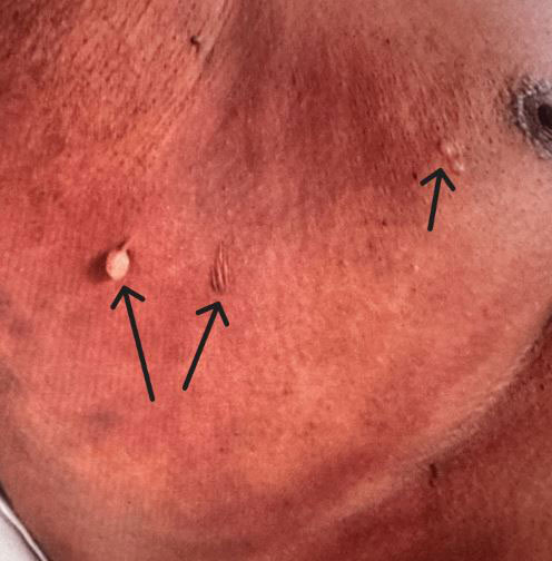 흔한 ‘이 약’ 먹었다가, 위급상황… 70대 男, 피부에 생긴 증상 보니?